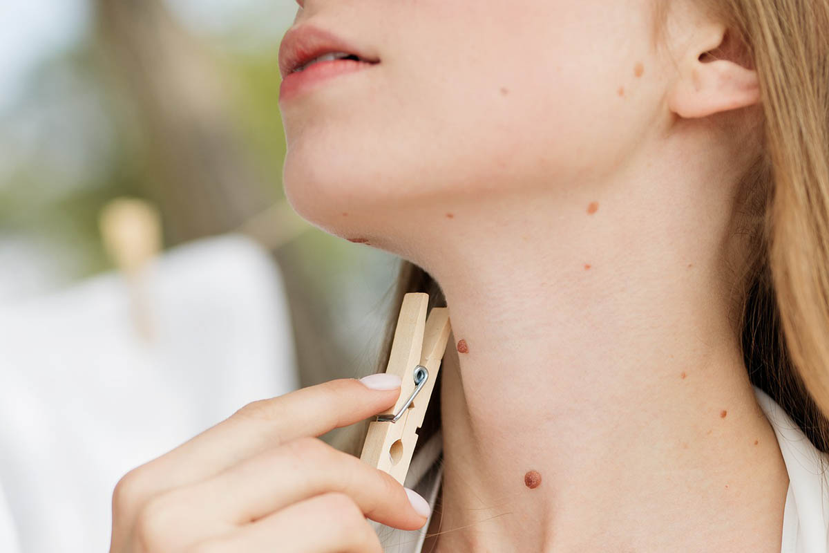 Girl with moles on her neck