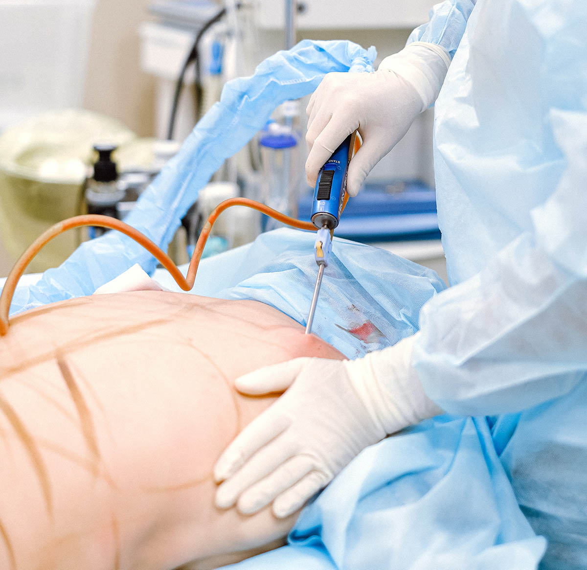 medical professional doing a liposuction on a patient