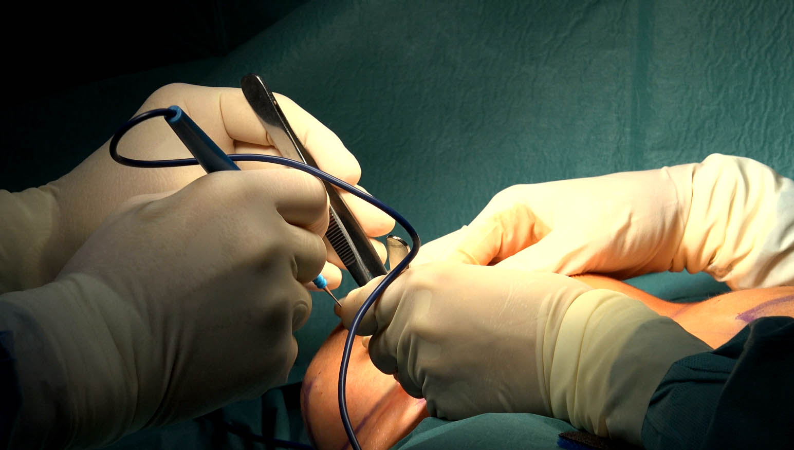 surgeons performing breast reduction surgery