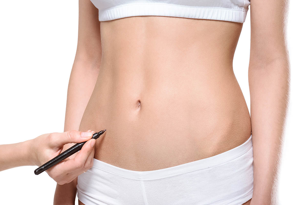 plastic surgeon marking area on stomach of patient for lipectomy procedure